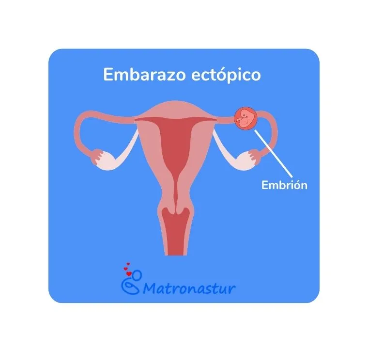 Descubre todo sobre el embarazo ectópico